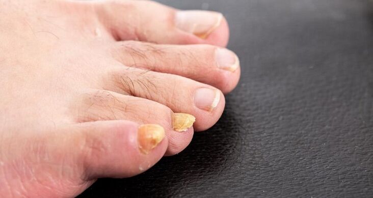 yellowing of nails with nribca on the feet