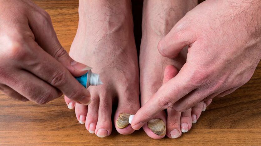 Applying an antifungal cream to your toenails to treat onychomycosis