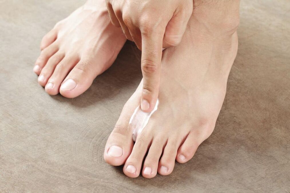 Application of a special ointment to treat the interdigital form of the foot fungus