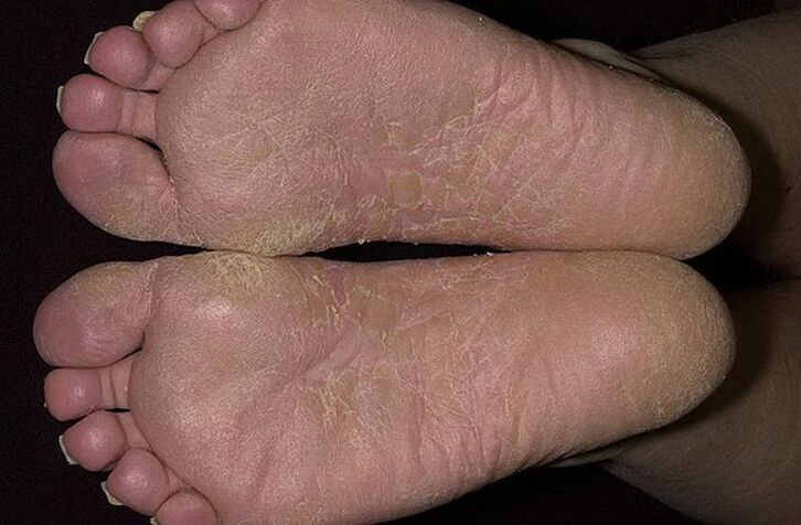 Dry, flaky skin of the feet is a sign of scaly mycosis