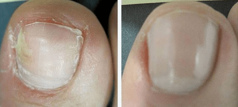 Toenail before and after the treatment of the fungus