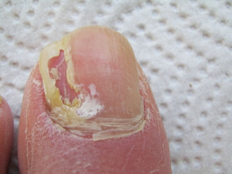 With onychomycosis, there is a deformation of the nail plate. 