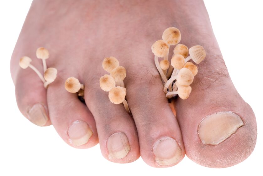 fungus between toes