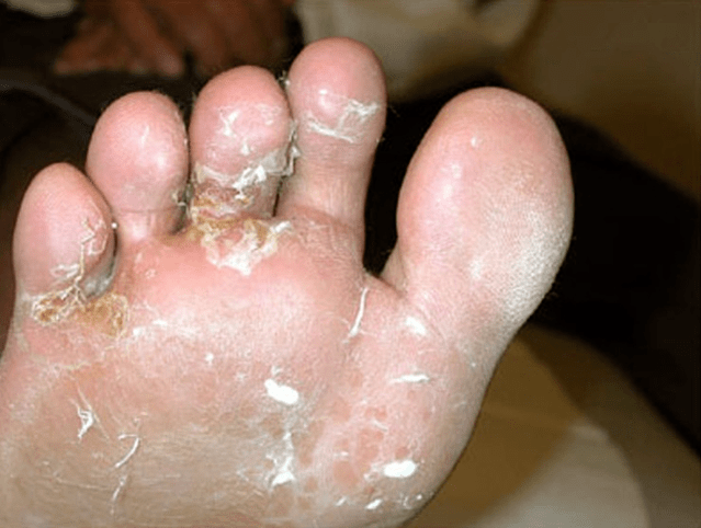 the development of fungus on the toes