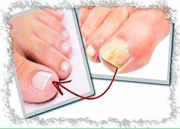 before and after toenail fungus treatment