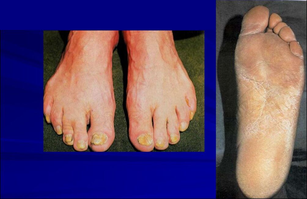 Squamous-hyperkeratotic form of the fungus (foot rubromycosis)