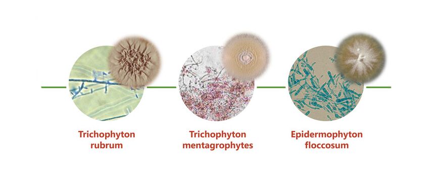 The main causative agents of skin fungus on the legs