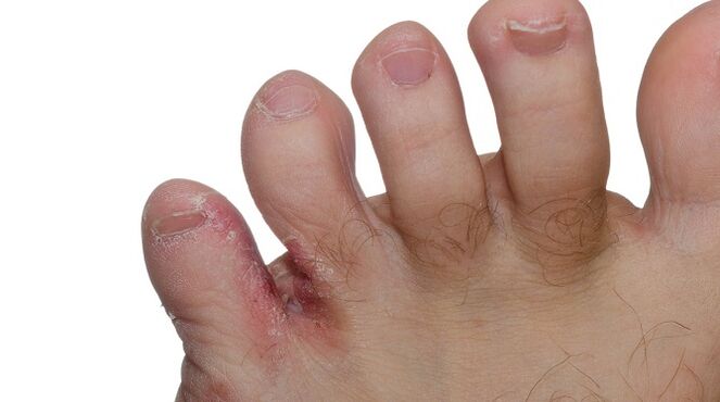 Signs of fungus between the toes - cracks and peeling skin