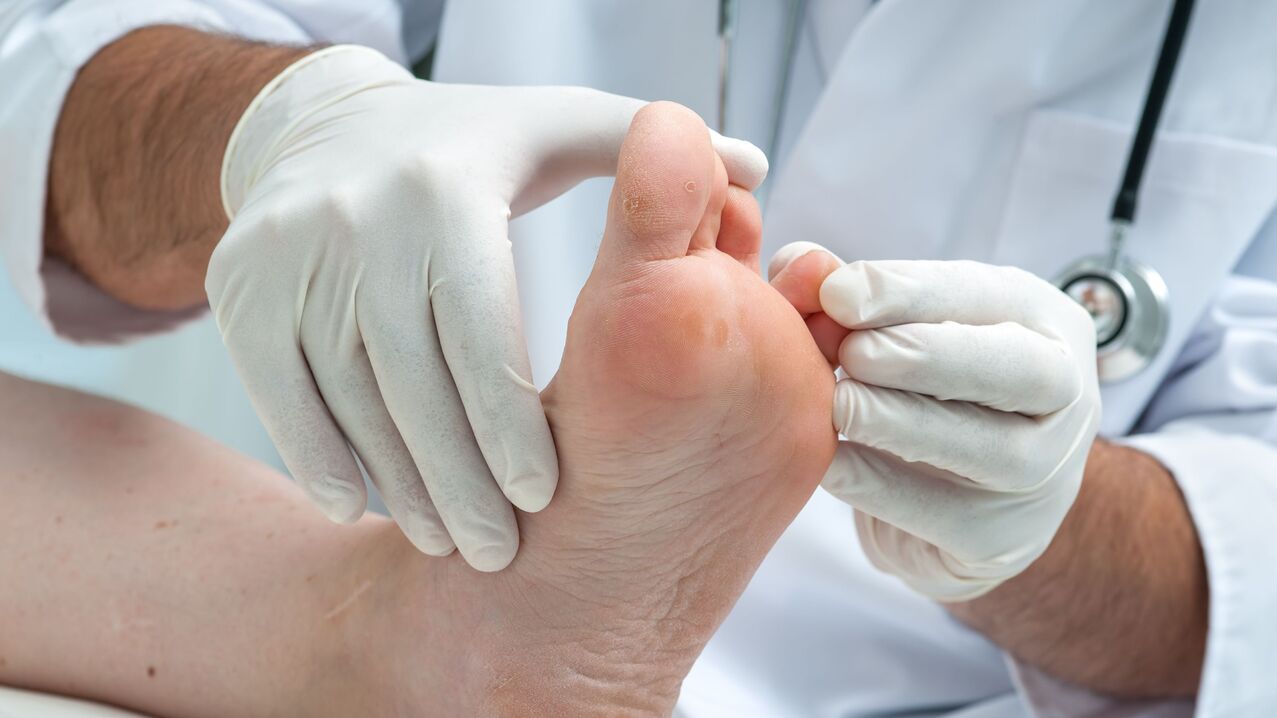 Diagnosis of foot fungus